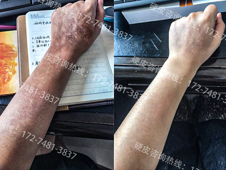 硬皮病案例带号码.png